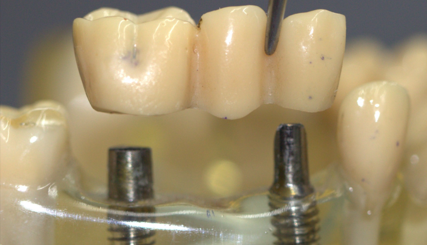 Dental Implants