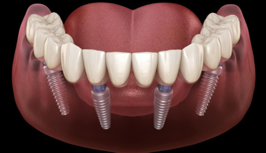 Dental Implants