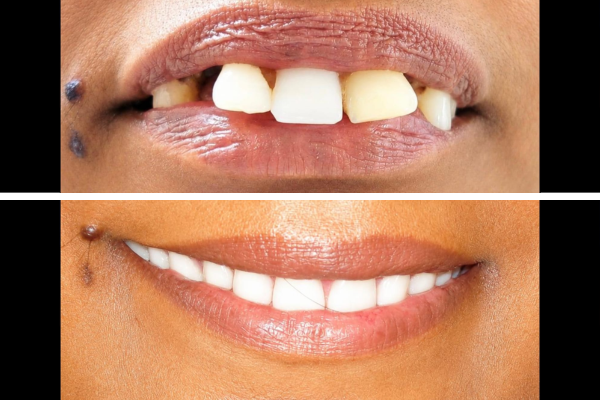 Full Mouth Rehabilitation