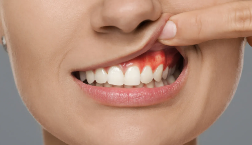 Dental Implants