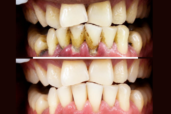 Gum Health
