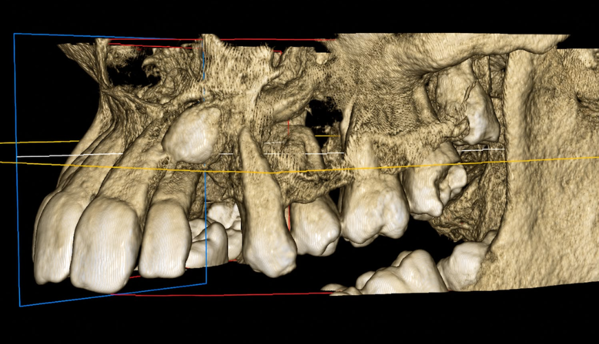 Dental Implants